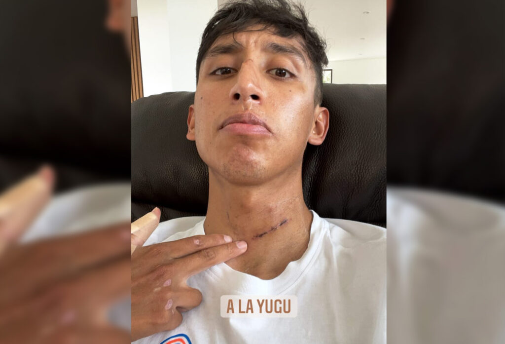 EGAN BERNAL MEUSTRA HERIDA ACCIDENTE